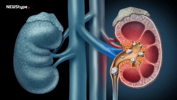 Kidney Stone health news